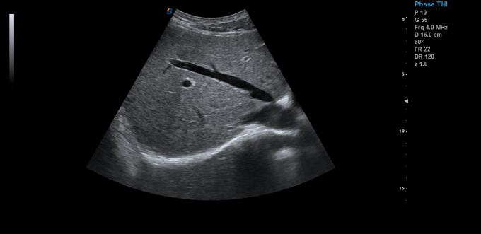 Linear Convex Probe Ipad Iphone Android Pocket Ultrasound Device 0