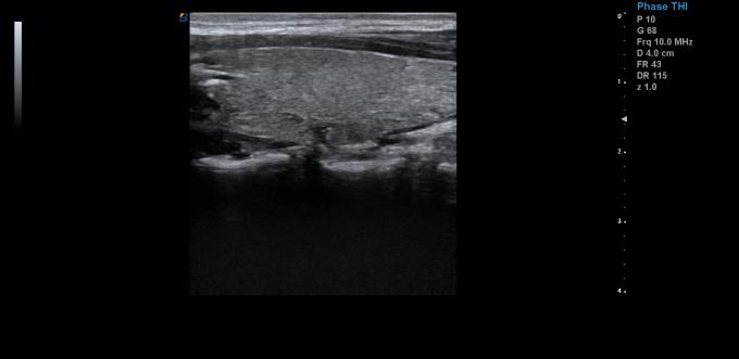 Linear Convex Probe Ipad Iphone Android Pocket Ultrasound Device 1