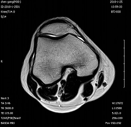 CE Permanent Magnet Cost Effective 0.3 Tesla Open MRI Machine For Medical Imaging BTI-030 1