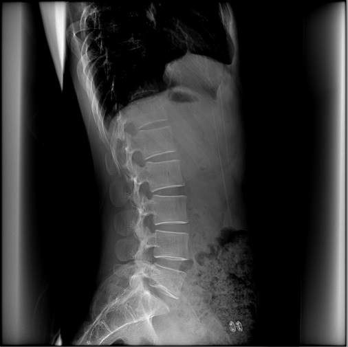 BTR-500/BTR640 Digital U-Arm X-Ray high power 50kW Power 0