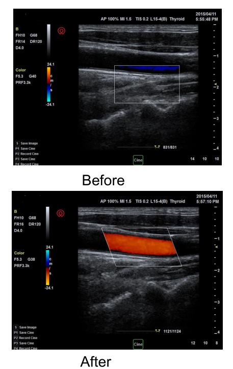 NMPA Andrology Doppler Ultrasound Machine 3D Color IMT BTH-50 0