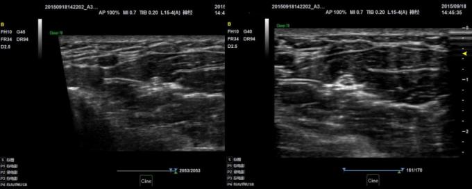 NMPA Andrology Doppler Ultrasound Machine 3D Color IMT BTH-50 8