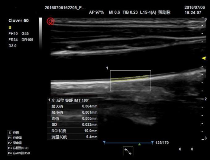 NMPA Andrology Doppler Ultrasound Machine 3D Color IMT BTH-50 2
