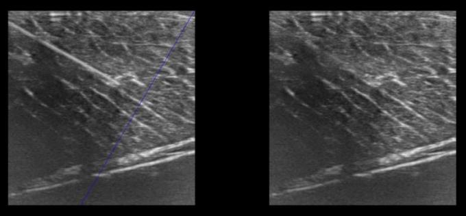 NMPA Andrology Doppler Ultrasound Machine 3D Color IMT BTH-50 1