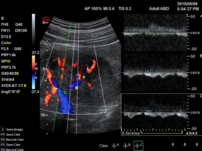 NMPA Andrology Doppler Ultrasound Machine 3D Color IMT BTH-50 4
