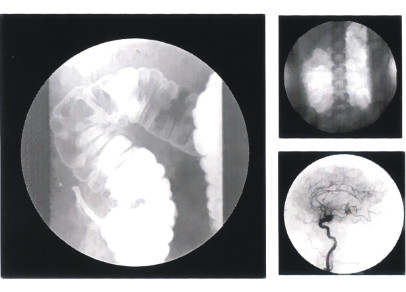 Digital Fluorioscopy System, Cost Effective, Good Images, High Resolution Monitor, 3 Fields Can Be Selected, Spot-Film 1
