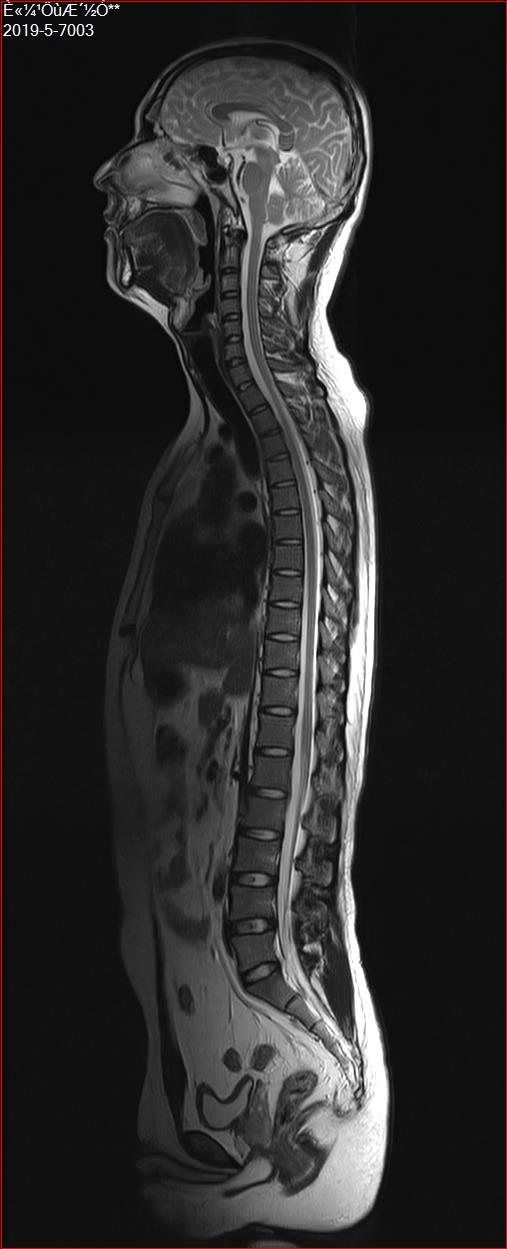 Helium Free Superconducting MRI Machine BSTAR-150 1.5 Tesla Zero Liter 2