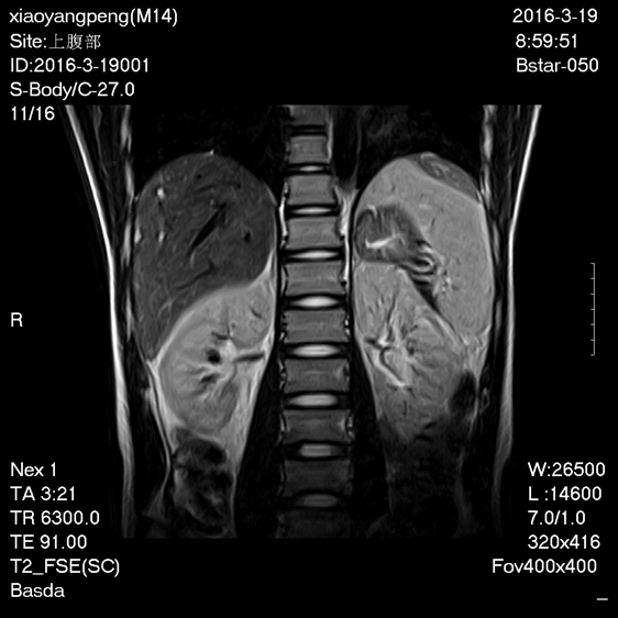 100 Liter No Claustrophobic Open MRI Machines 0.5t Superconductive Large Aperture Bstar-050 0