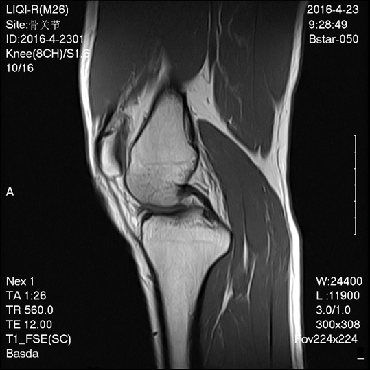Helium Magnet 0.5 Tesla Open Mri Machines Niobium Titanium Alloy Material Bstar-050 1