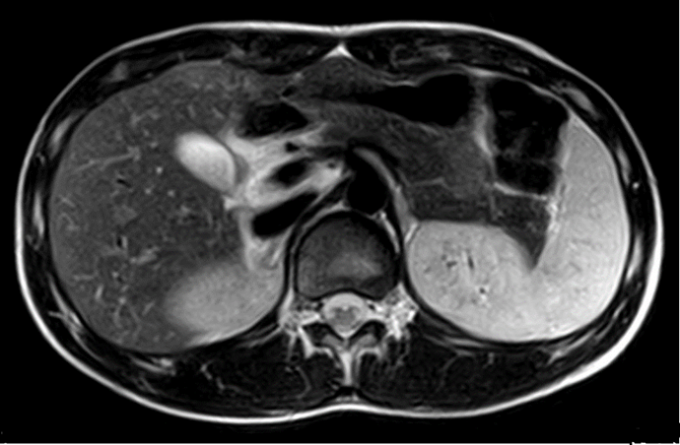 0.5 Tesla Superconductive MRI Scan Machine Double Columns Magnetic Exterior Bstar-050 0