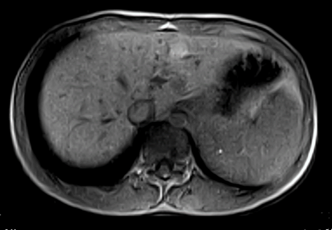 0.5 Tesla Superconductive MRI Scan Machine Double Columns Magnetic Exterior Bstar-050 1